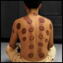Banner Image for Cupping: What Are Those Spots?!