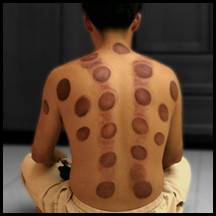 Resultado de imagen de cupping